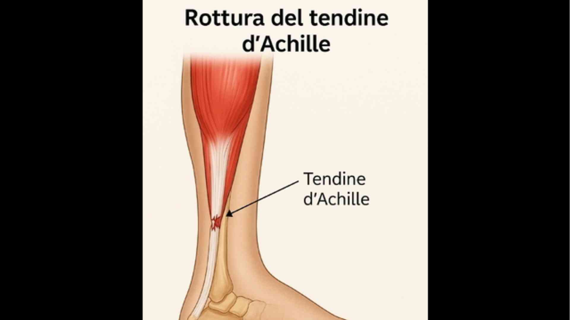 Tendine d’Achille, tempi di recupero più rapidi con le nuove tecniche mini-invasive