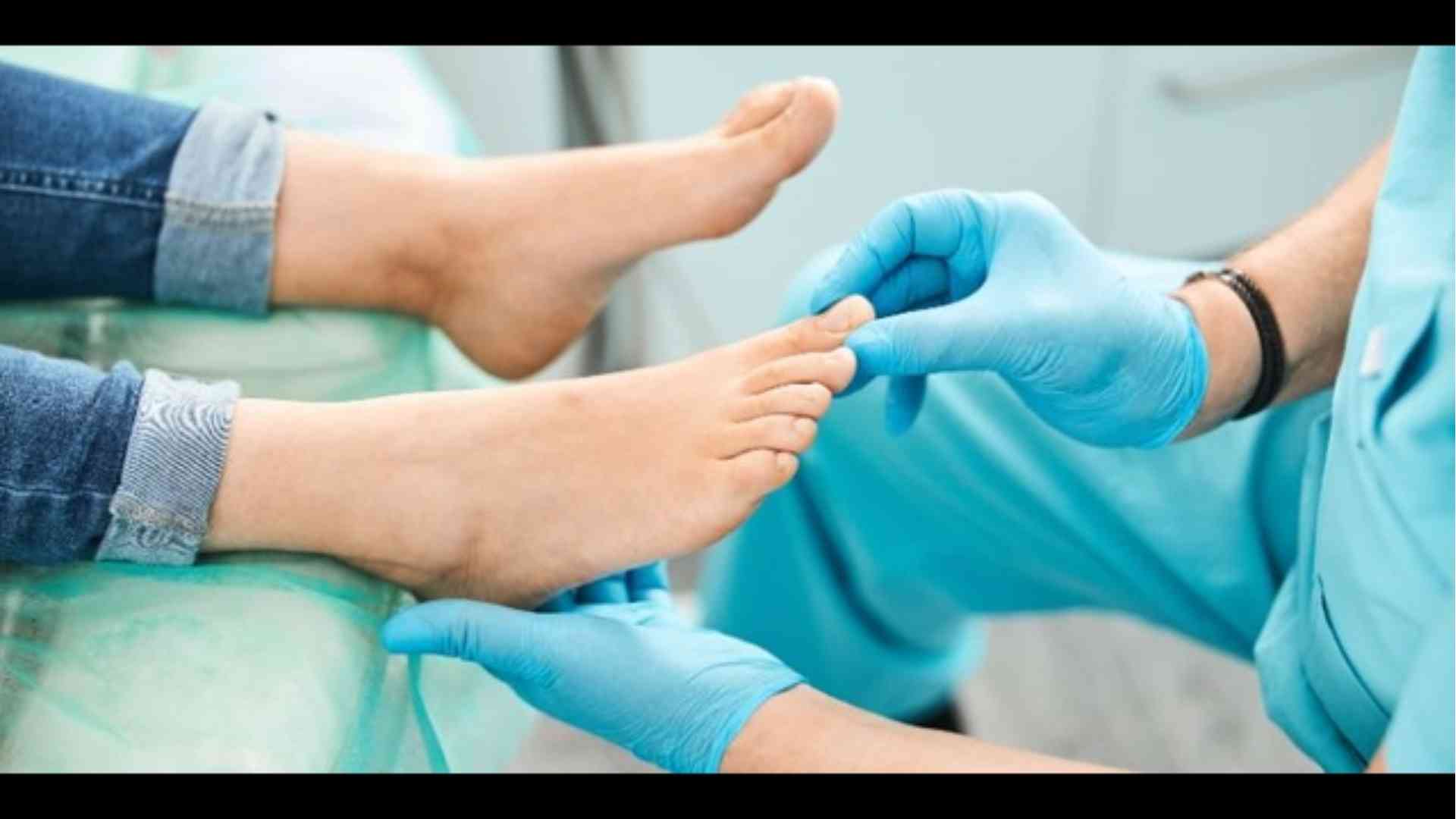 Alluce valgo, una nuova tecnica mini-invasiva migliora tempi di recupero e risultati estetici