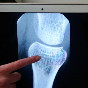 Osteoporosi, tre giornate per prevenirla e riconoscerla