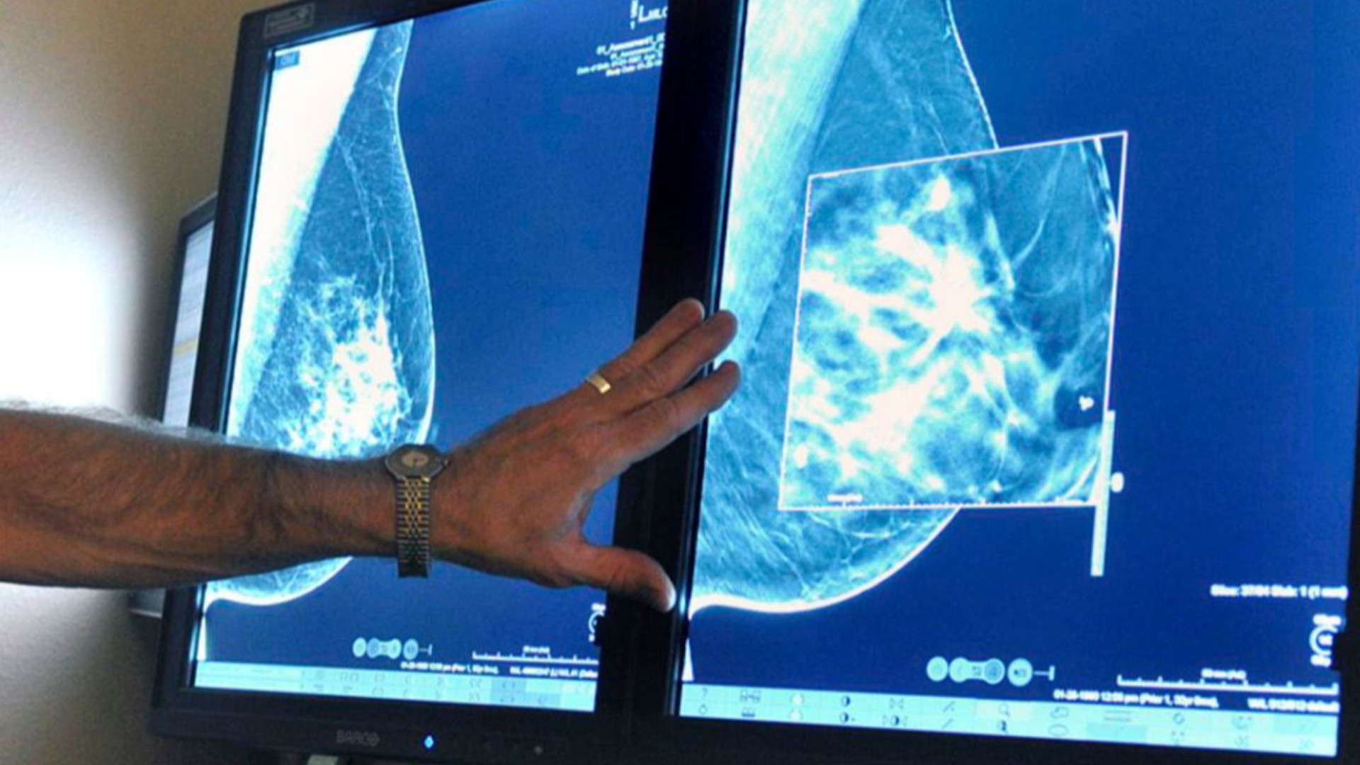 Mammografia di controllo «Prima data disponibile maggio 2027»