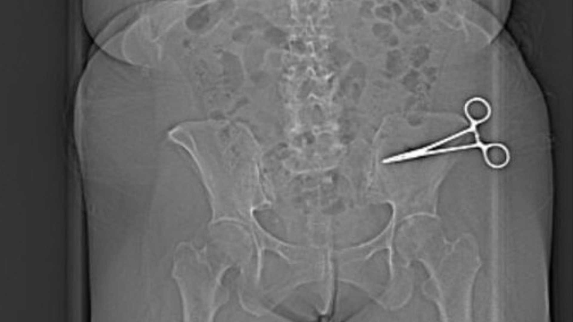 Fiorenzuola, resta 7 mesi con una forbice dimenticata nella pancia dopo un intervento