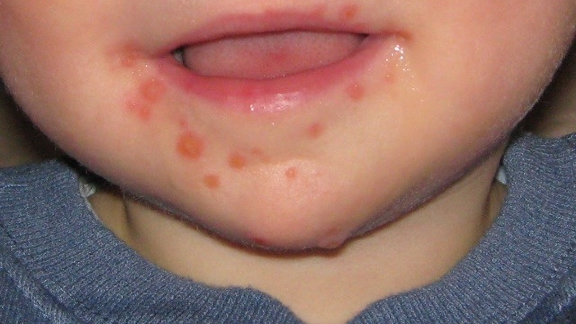 Virus mano-piede-bocca: centinaia di bimbi colpiti