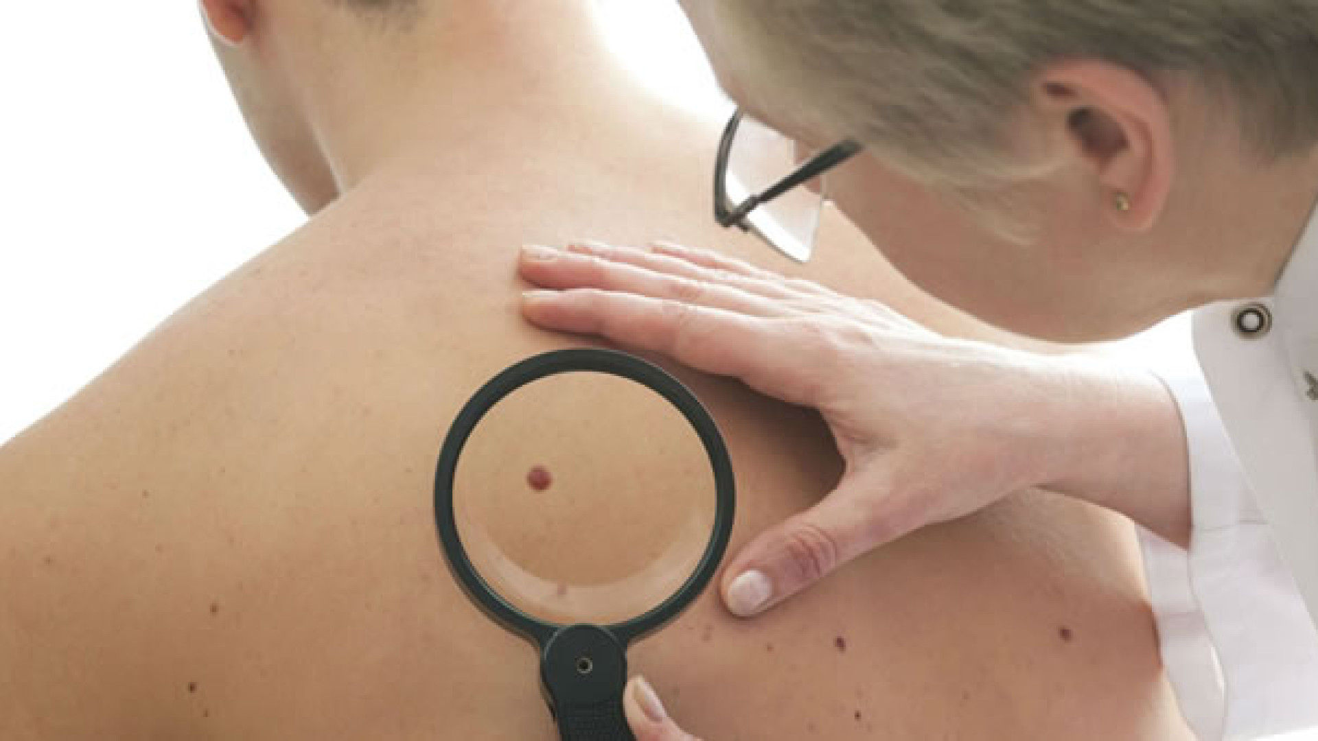 "Melanoma day" a Castel San Giovanni. "La migliore cura è la prevenzione"