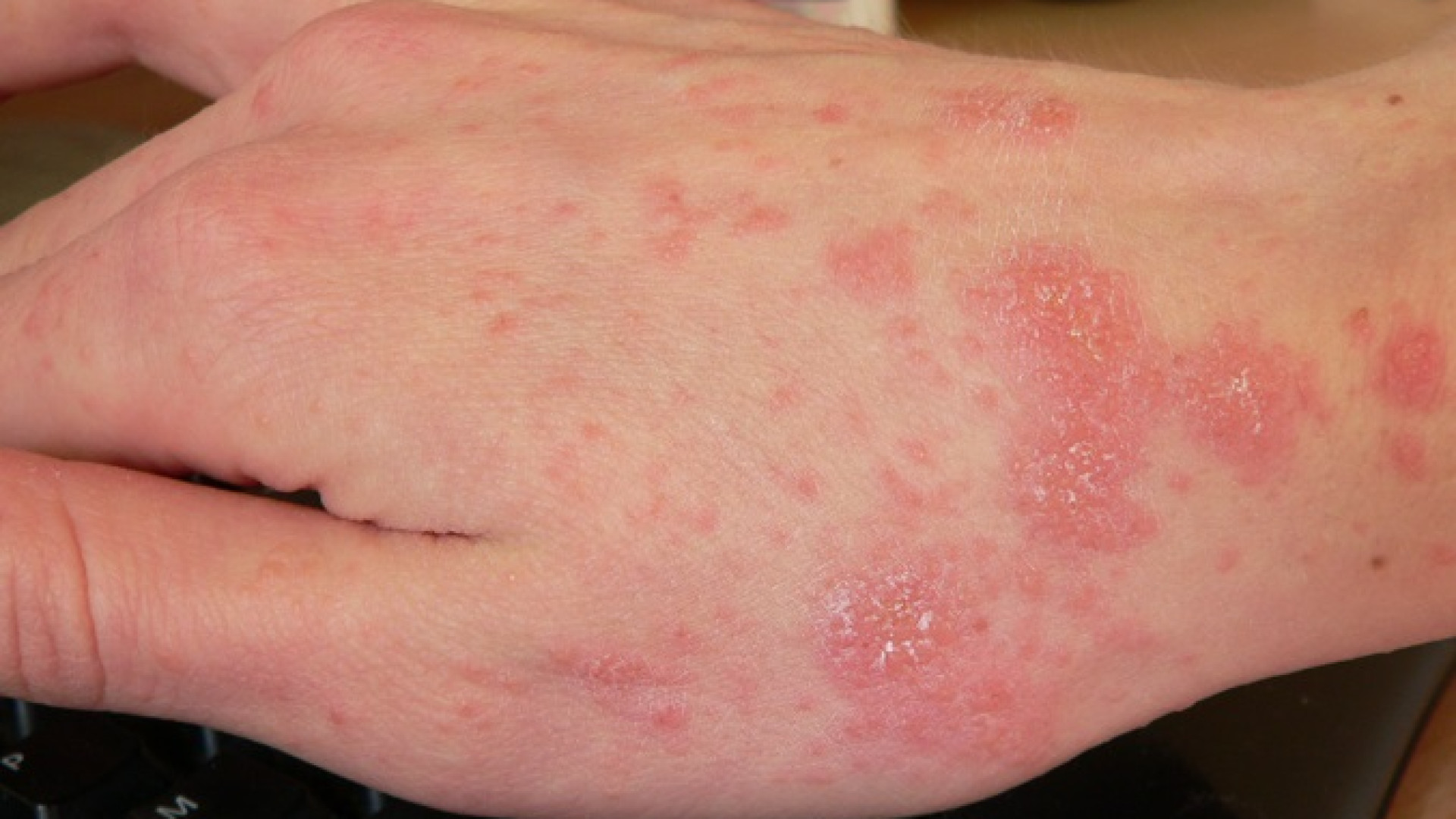 Aumenta la scabbia, l’esperto: “Può contagiare chiunque”