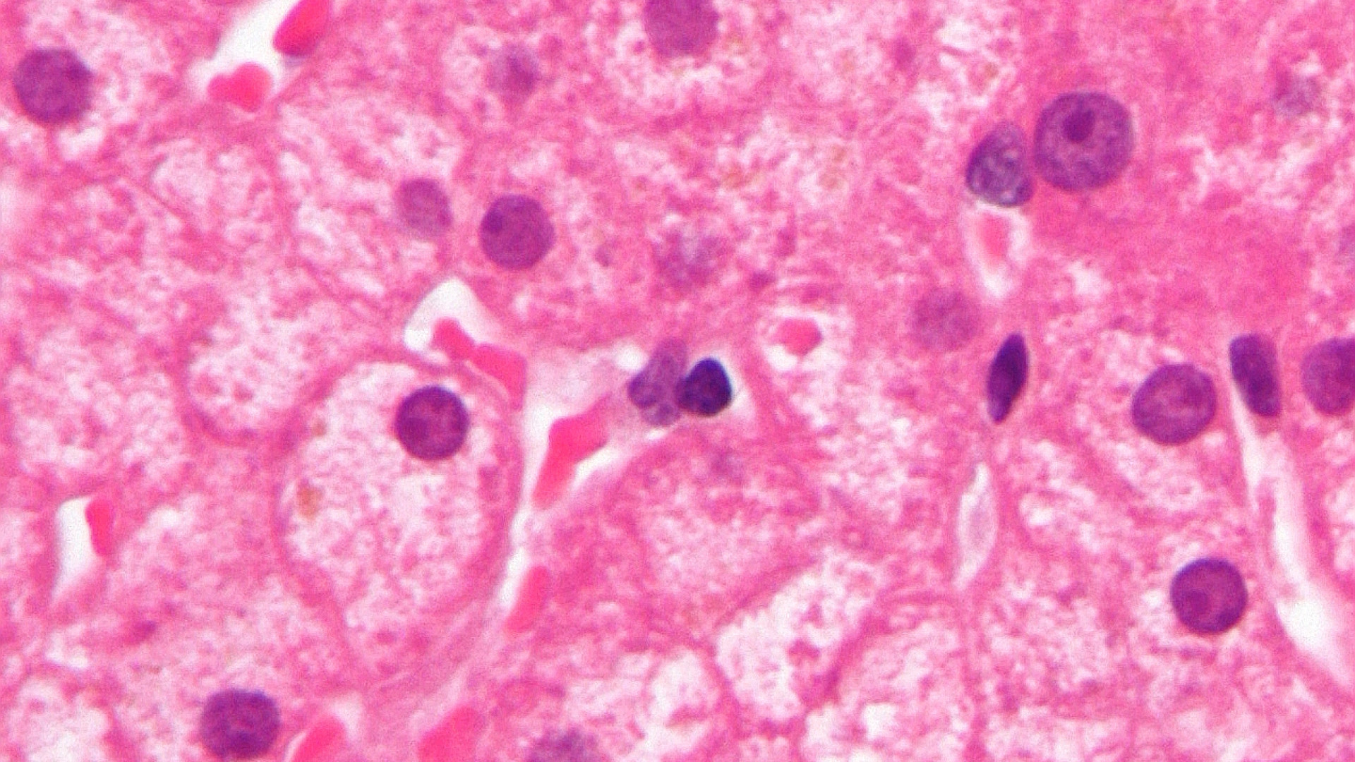 Epatite C: 150 persone in attesa delle nuove cure, 9mila potenziali malati