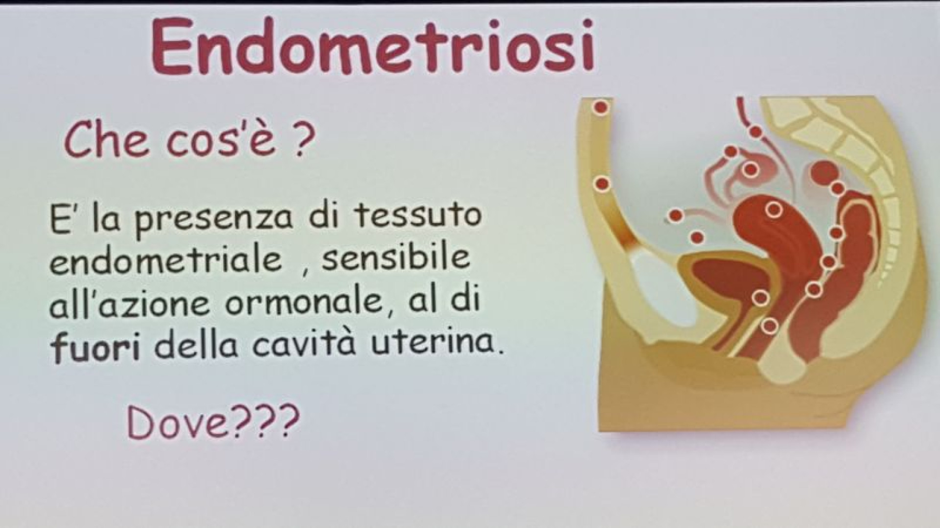 Endometriosi: "Colpisce 3 milioni di donne e senza cura". Convegno a Piacenza