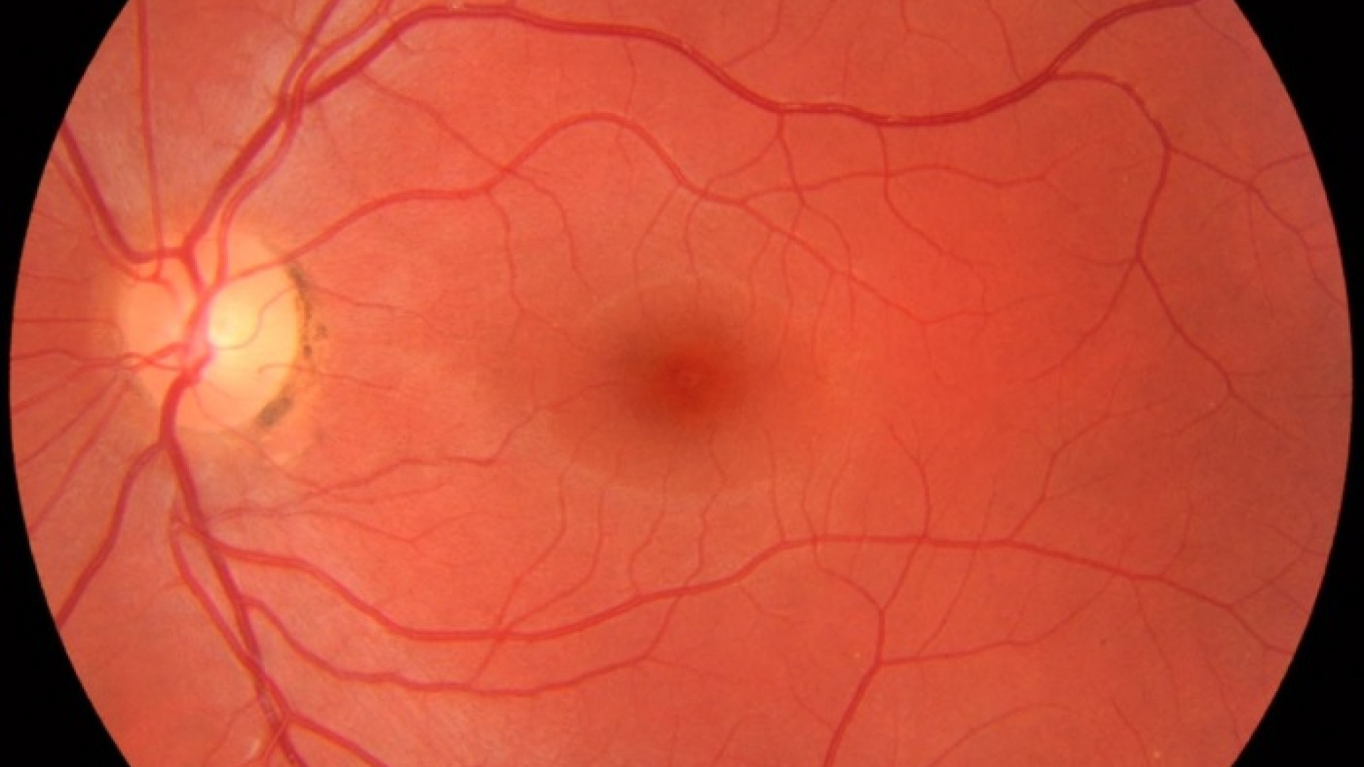 La morte è irreversibile? Riportate in vita le cellule nervose della retina