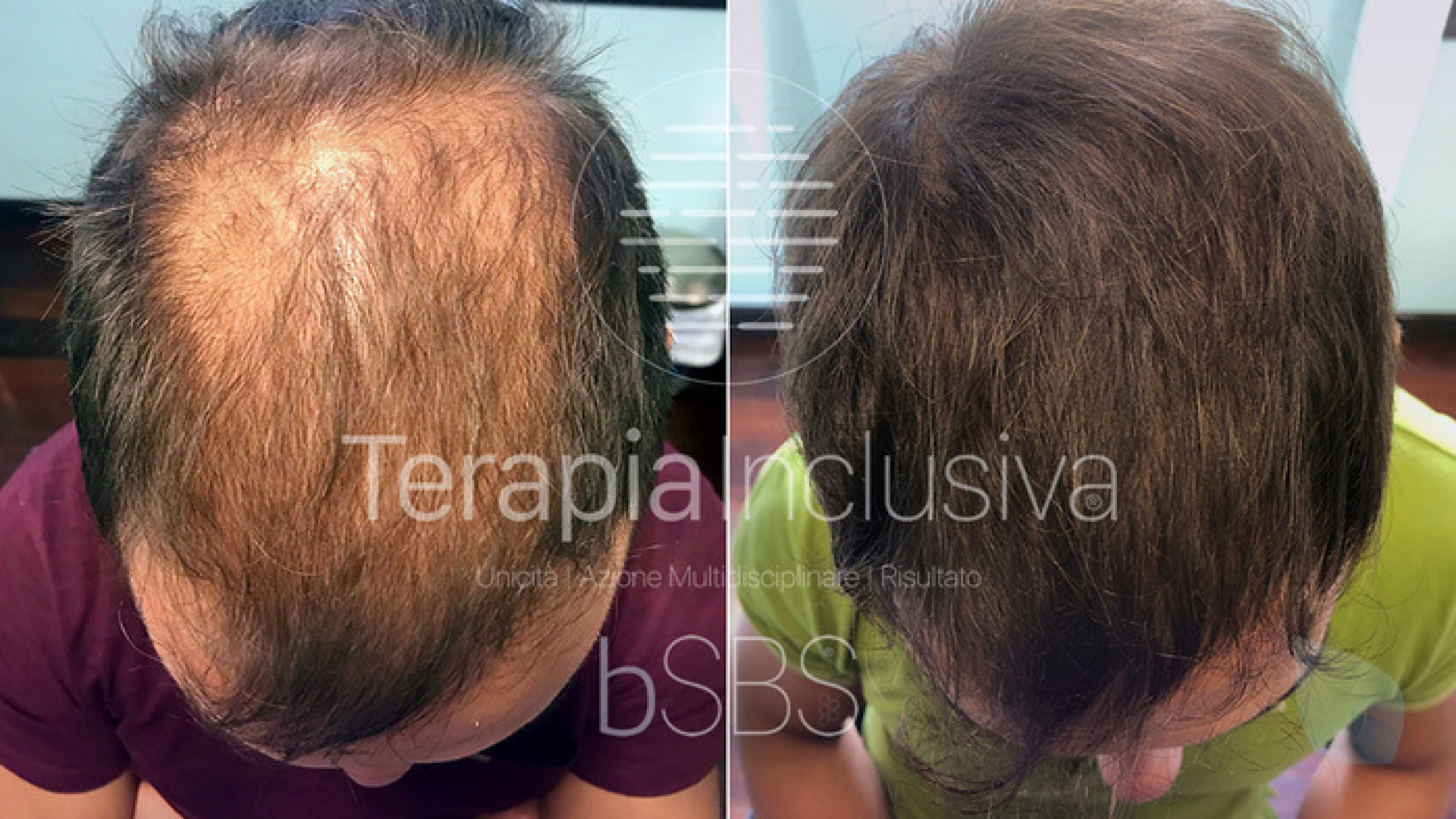 Calvizie, la Medicina Rigenerativa Inclusiva è la nuova frontiera